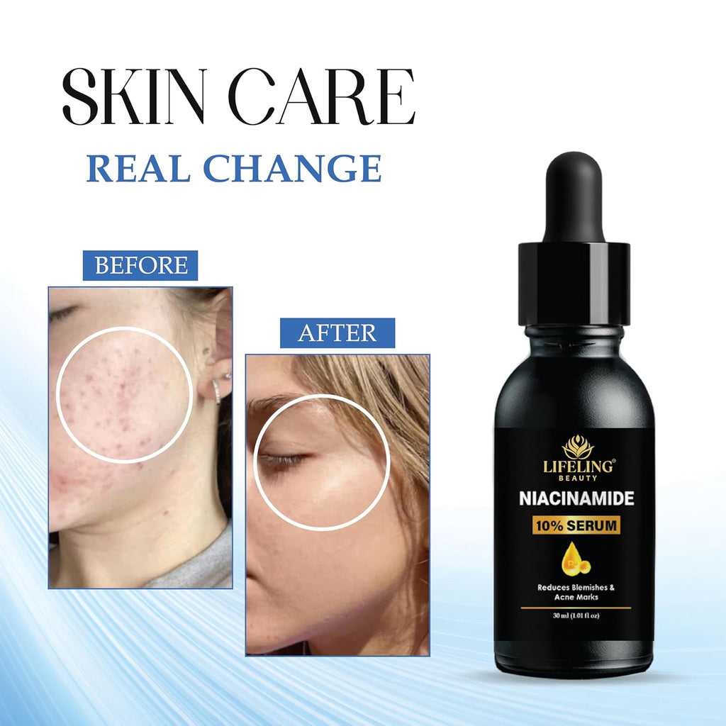 LIFELING BEAUTY Niacinamide 10% Face Serum, Reduces Blemishes & Acne Marks, Minimises Pores, 30ml